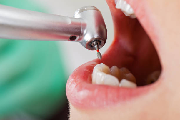 Best Lost Filling or Crown Replacement in Cairo, IL
